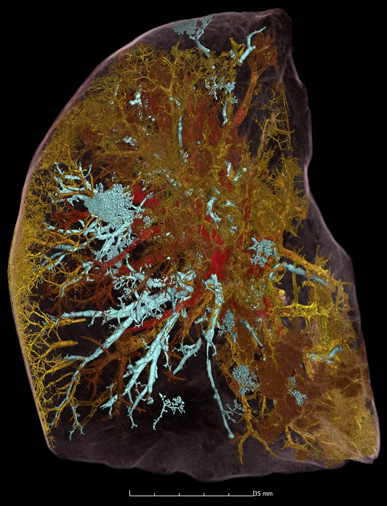 新型コロナ感染症で死亡した54歳男性の肺葉内の血管系のHiP-CTスキャン画像。重症患者の肺の血管が激しく損傷していることがわかる。画像は、気腔を水色で、閉塞していない血管を赤で、閉塞し、損傷した血管を黄色で色分けしてある。（PHOTOGRAPH BY ESRF, HUMAN ORGAN ATLAS）